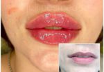 Обучение иньекциям увеличению губ! Топ техники КП губ