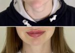 Модели на увеличение губ